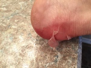 020717 Blisters right heel